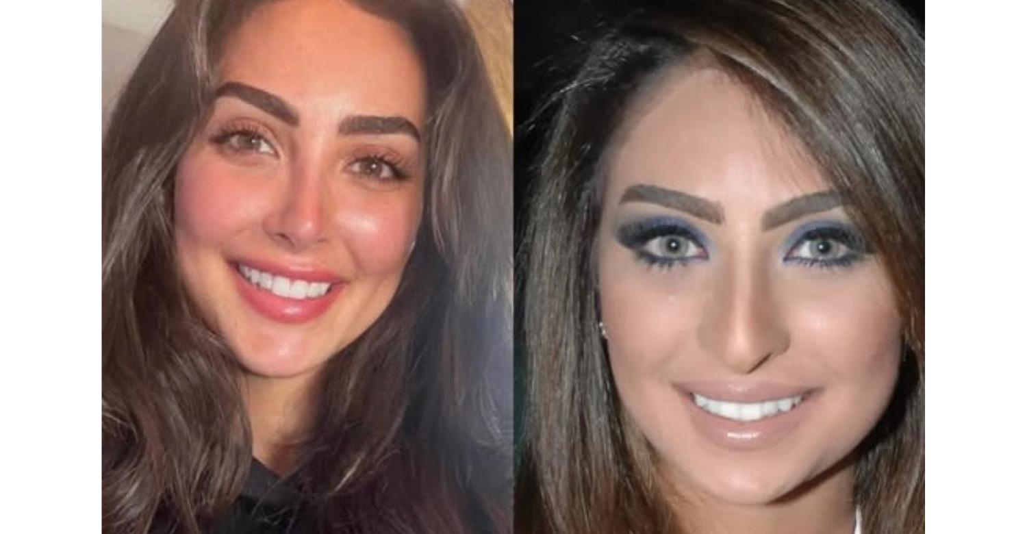 Nour alghandour before and after
